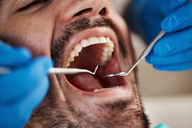 Best Emergency Wisdom Teeth Removal in Bogata, TX