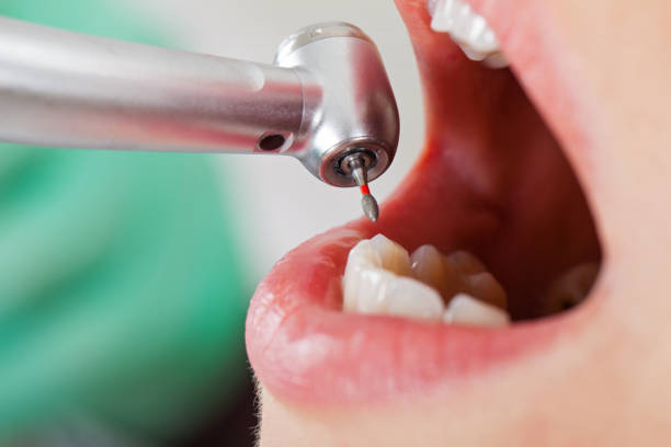 Best Emergency Treatment for Dental Infections or Abscesses in Bogata, TX